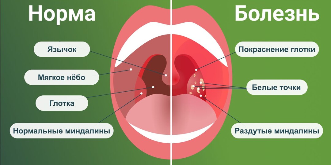 Первые симптомы ангины: как не перепутать с простудой