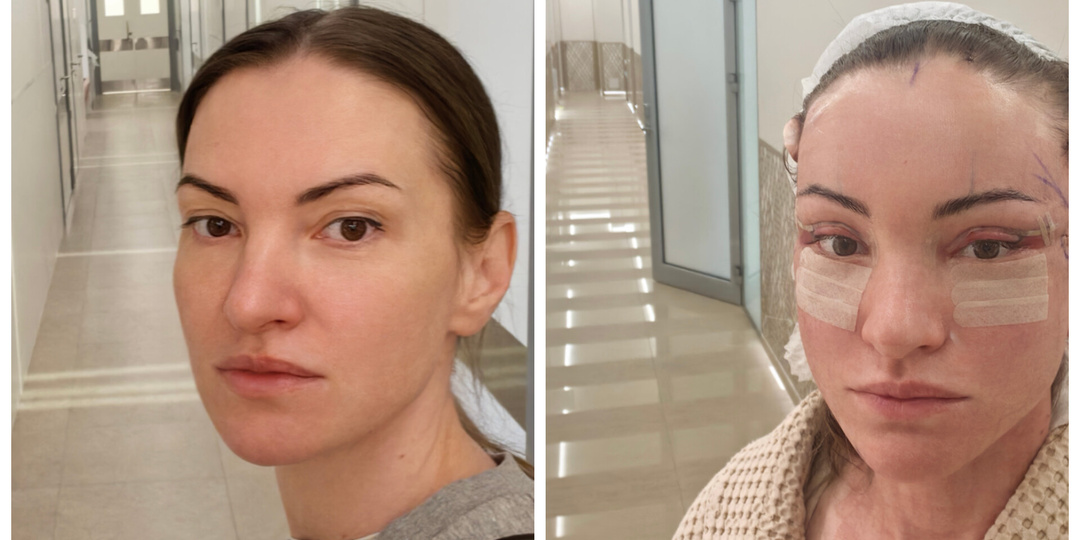 Сделала пластику, потому что надоело оправдываться, что я ее не делала!