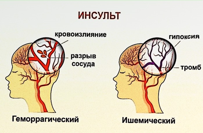 Инсульт: Что Делать, Если Случилось Несчастье