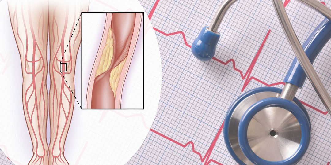 Как понять, что у вас атеросклероз артерий ног: первые «звоночки», которые нельзя игнорировать