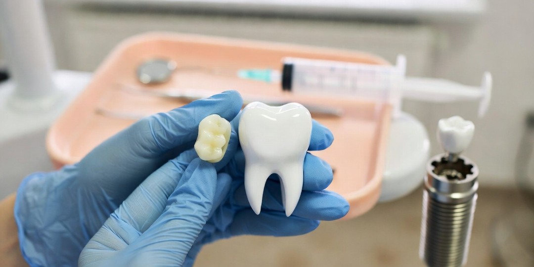 «Отбелить и вставить»: можно ли совмещать отбеливание зубов и имплантацию — и как не испортить себе улыбку