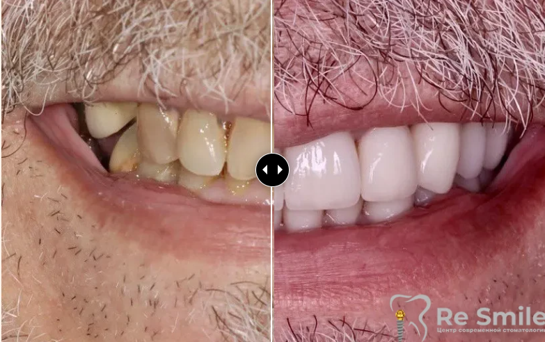 В клинику обратился пациент с жалобами на неудовлетворительную эстетику зубного ряда и частичное отсутствие зубов в жевательных отделах на обеих челюстях.

Была проведена полная санация полости рта. Установлены импланты в области отсутствующих зубов. Также, установлены циркониевые коронки на своих зубах и на имплантах.