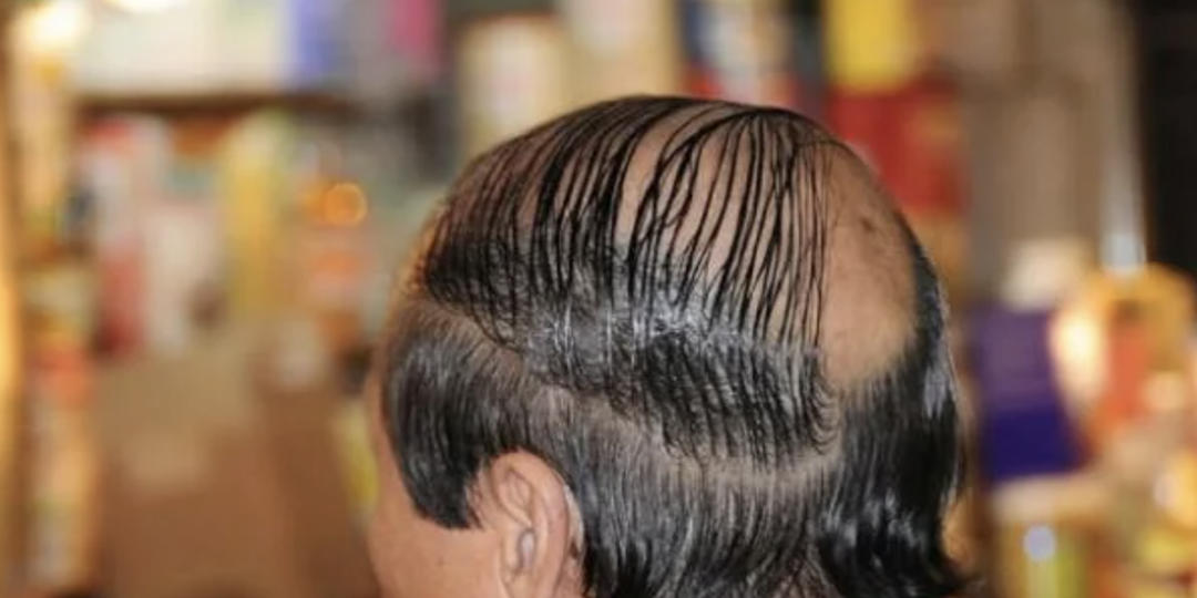 Пересадка волос: как понять что уже пора?