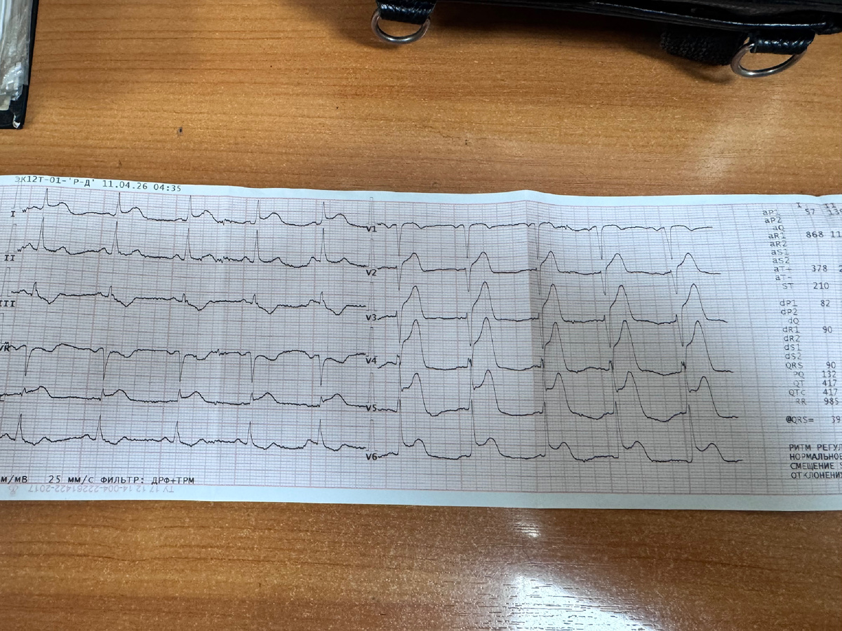 Исходная ЭКГ, запись через несколько минут после приезда бригады 