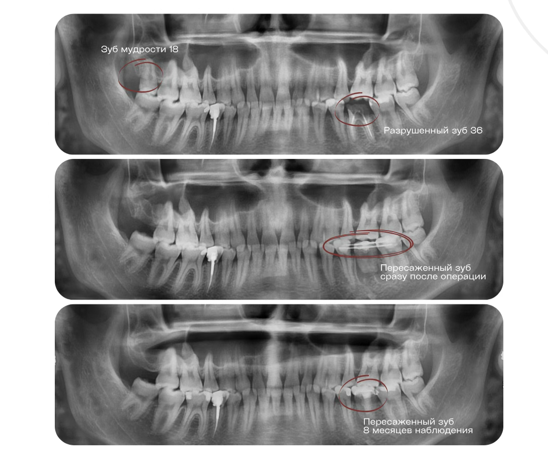 КТ на этапах дечения
