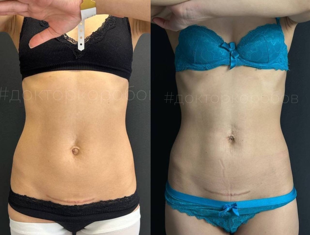 Ушивание диастаза и пупочной грыжи авторским методом через пупочный доступ. Результат через 6 месяцев после операции. Пациентка попросила сохранить шов от КС. Операция была выполнена более чем через год после родов.