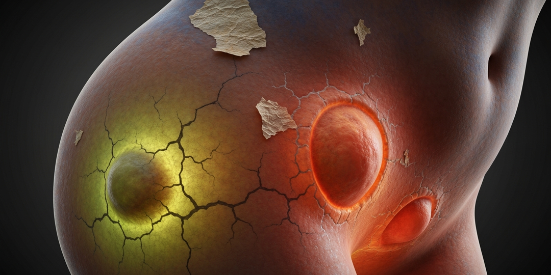 Как выглядит целлюлит: стадии, которые вы не замечали