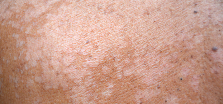 "Солнечный грибок": правда и вымысел о белых пятнах на коже