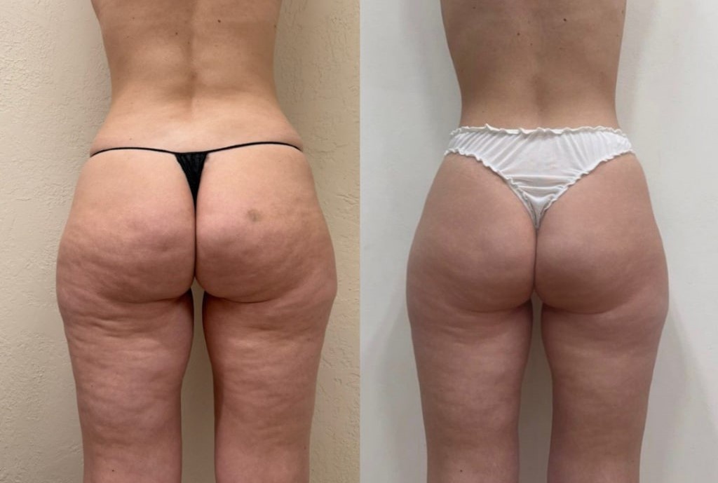 Результат курса процедур на косметике CELLOOE