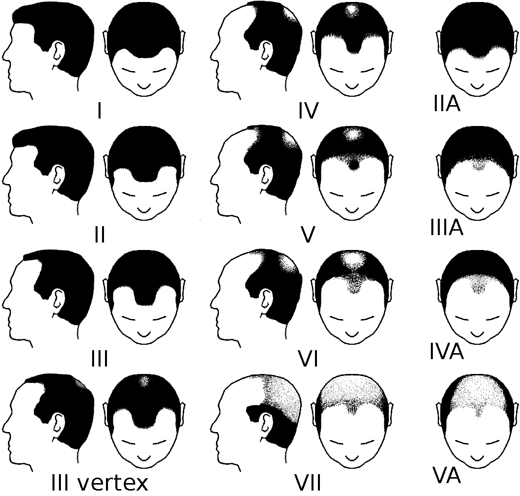 Изображение взято с сайта https://commons.wikimedia.org/wiki/File:Partial_Norwood_scale_for_male_pattern_baldness.png