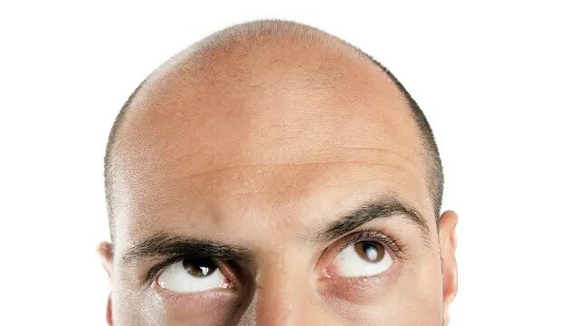 Изображение взято с https://ichef.bbci.co.uk/ace/ws/640/amz/worldservice/live/assets/images/2015/12/17/151217150052_bald_man_640x360_thinkstock_nocredit.jpg.webp