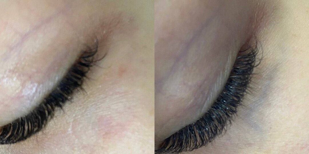 Сосудистая сетка под глазами — можно ли убрать?