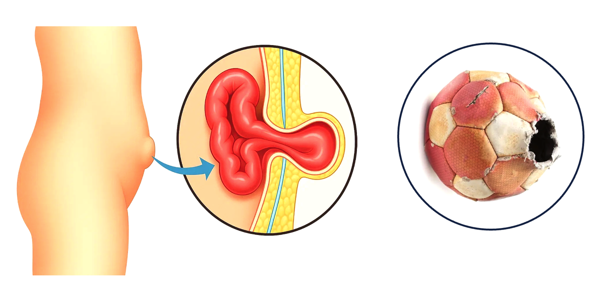 В брюшной полости (как и в камере мяча) есть постоянное давление, которое выталкивает ее органы через образовавшееся слабое место/дефект в мышечно-апоневротическом слое (это и есть грыжа). 