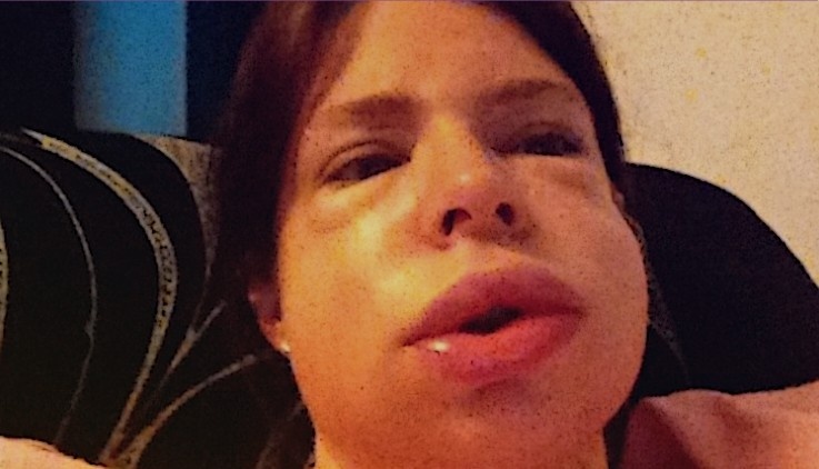 Ангионевротический отек: что нужно знать о отеке Квинке