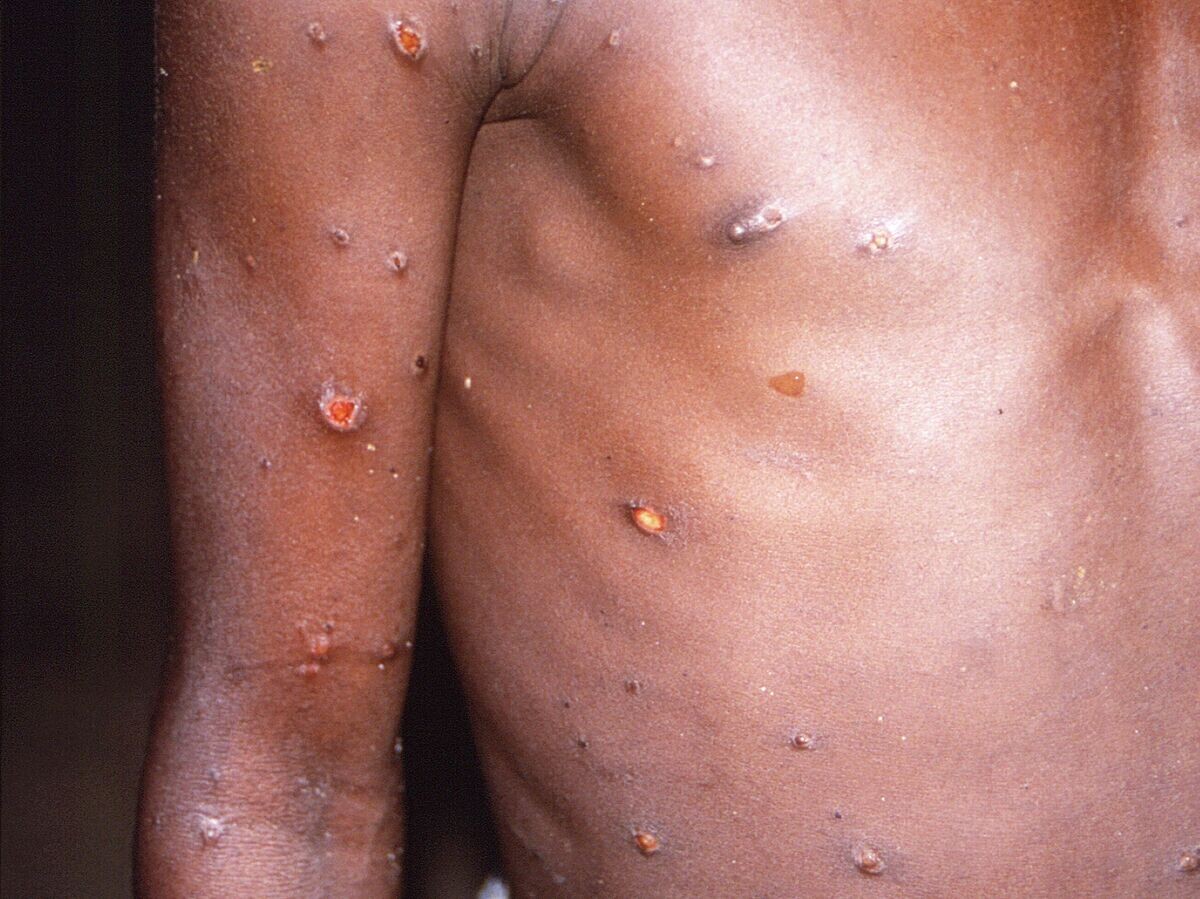    Пациент с оспой обезьян | © AP Photo / CDC