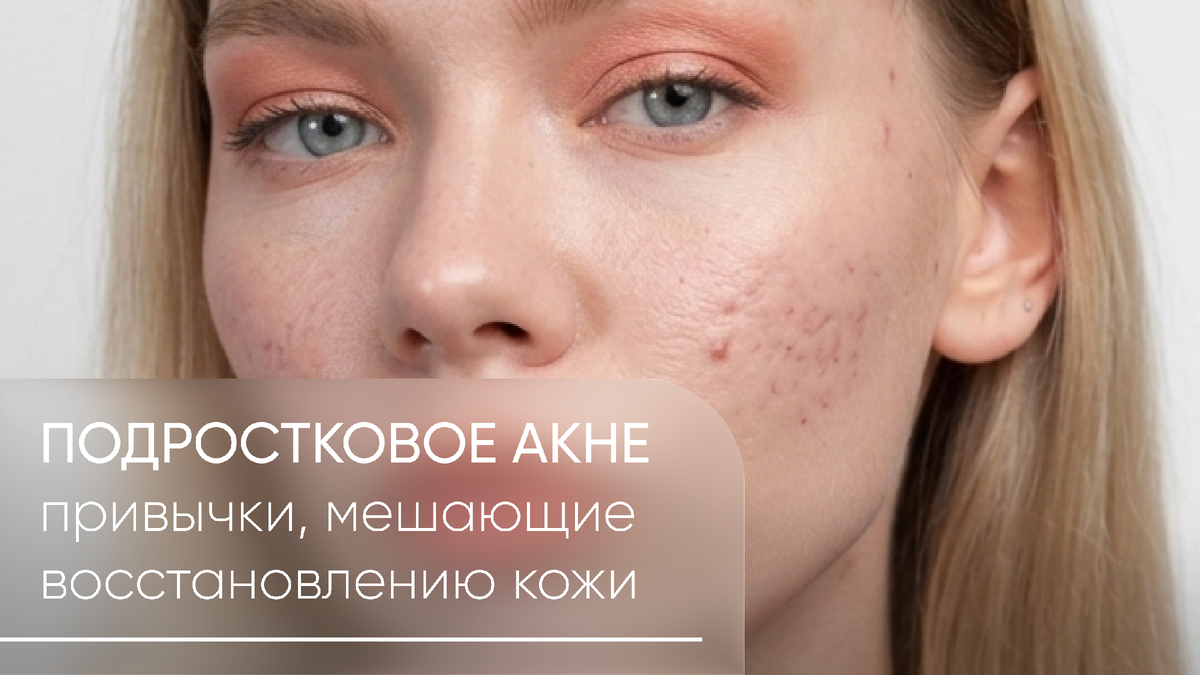 Привычки у подростков, которые мешают здоровой коже