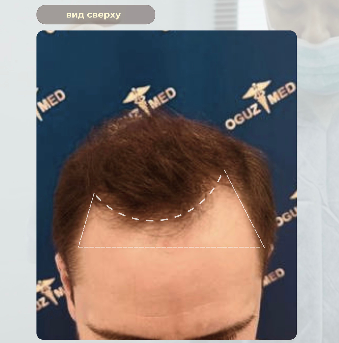 Изображение: кейс ОгузМед, до пересадки волос