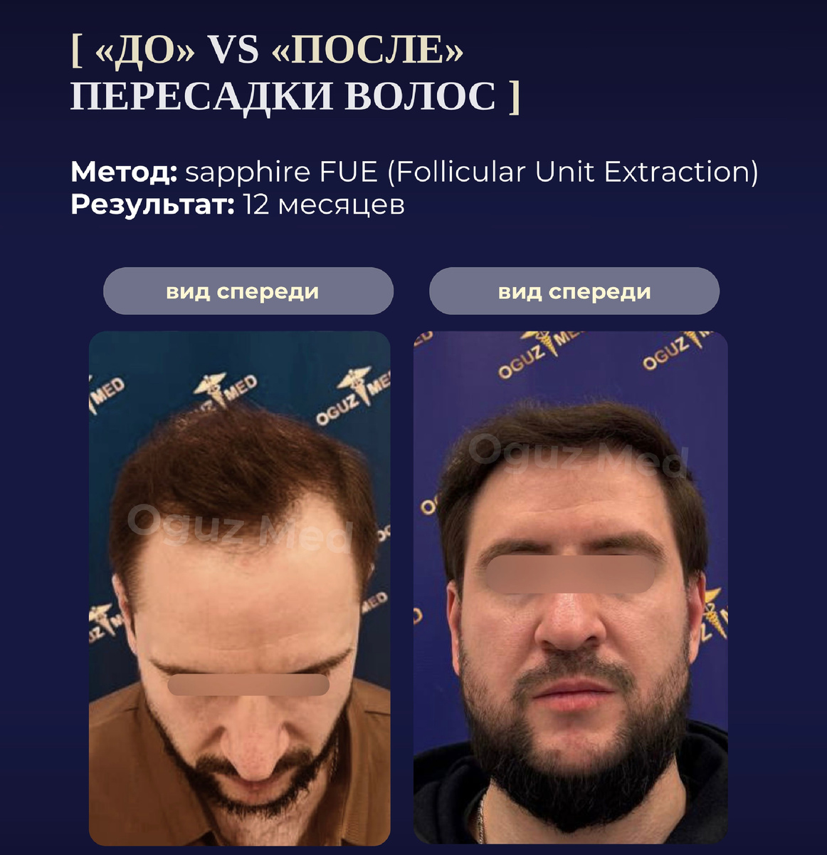 Изображение: кейс ОгузМед, до и после пересадки волос
