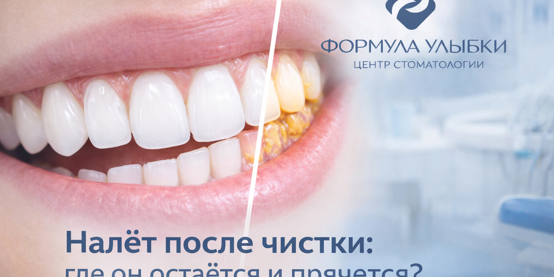Налёт на зубах – почему он остаётся даже после чистки и где прячется