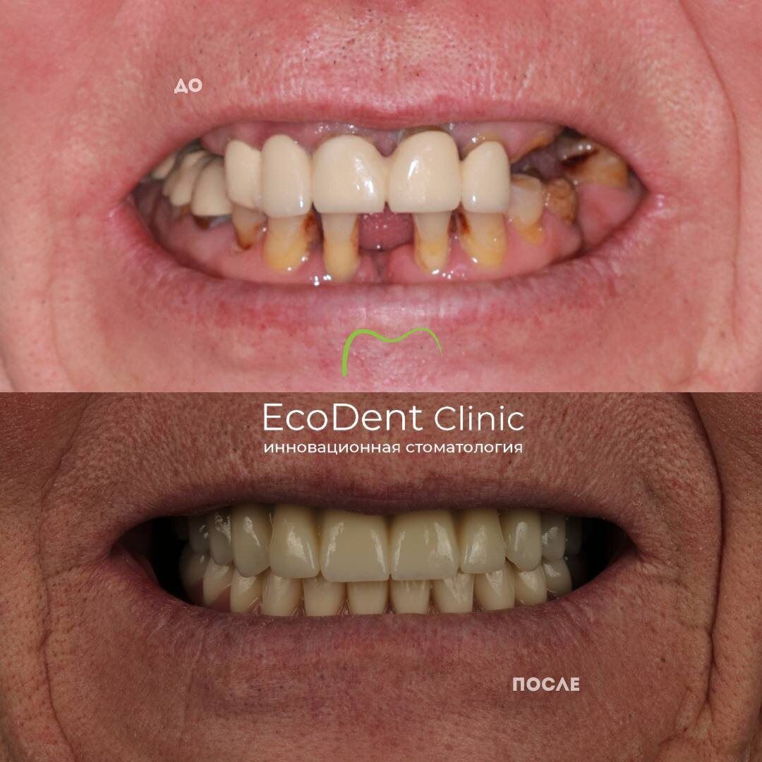 «Все на 6 имплантах», клиника ЭкоДент, Астрахань