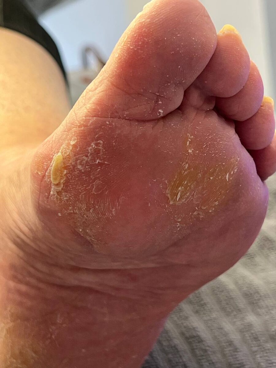 Стопа до обращения к подологу