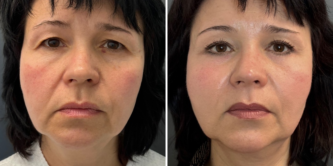 ‼️Результат омоложения верхней и средней зон лица на сроке 9 месяцев после операции