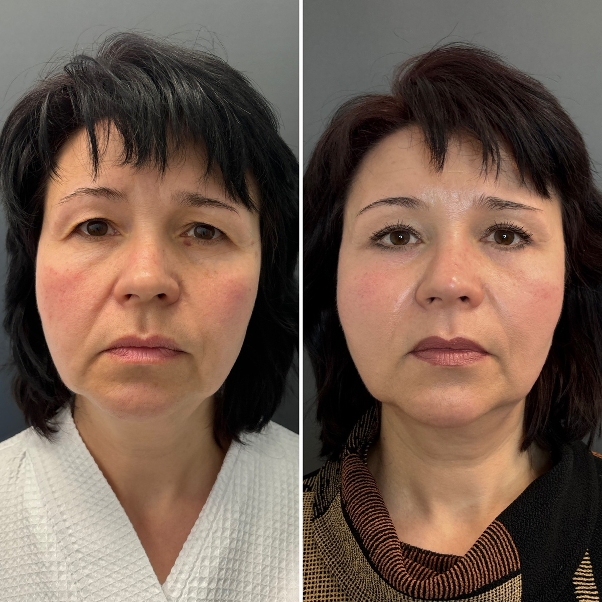 Эндоскопический лифтинг верхней и средней третей лица, блефаропластика: результат 9 месяцев после операции ( слева- до, справа- после операции). Хирург Остринская Т.В. 