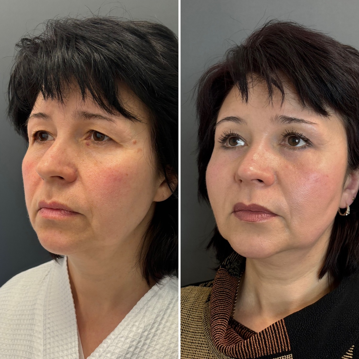 Эндоскопический лифтинг верхней и средней третей лица, блефаропластика: результат 9 месяцев после операции ( слева- до, справа- после операции). Хирург Остринская Т.В. 