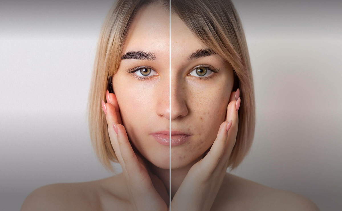 Как правильно и эффективно лечить акне? Можно ли начинать лечение летом?