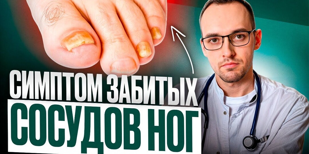 Симптомы Атеросклероза: Как Понять, Что Сосуды Сужаются