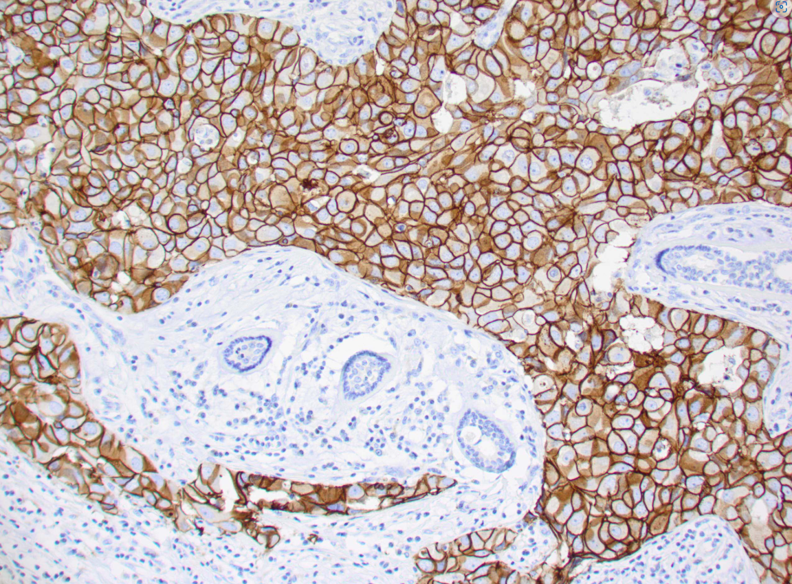 Вид под микроскопом. Коричневым цветом окрашиваются HER2-положительные клетки рака молочной железы