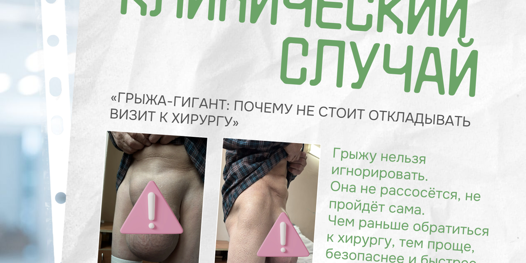 Грыжа-гигант: почему не стоит откладывать визит к хирургу