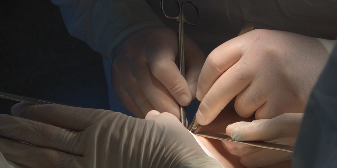 Балаковские хирурги спасли пациента с гигантской грыжей