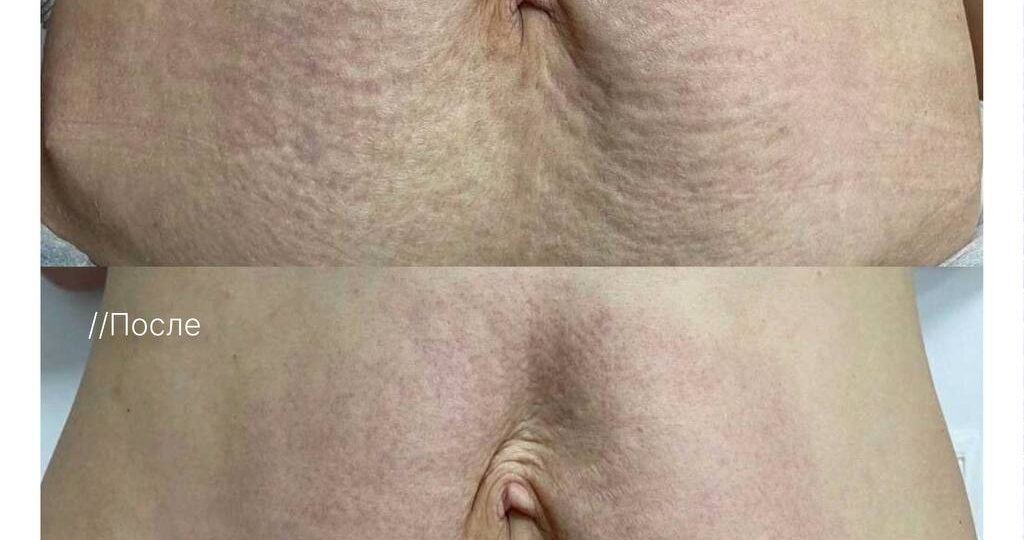 После похудения вы потеряли вес