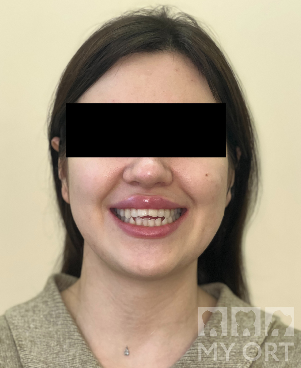 Фото. Зубы пациентки до лечения. Листайте.