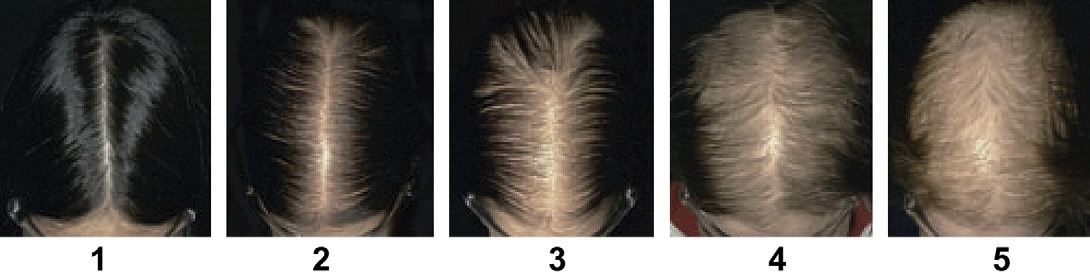 Изображение: степени женской алопеции