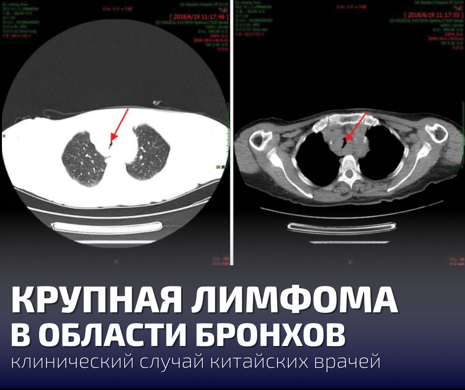 Крупная лимфома в области бронхов: клинический случай китайских врачей