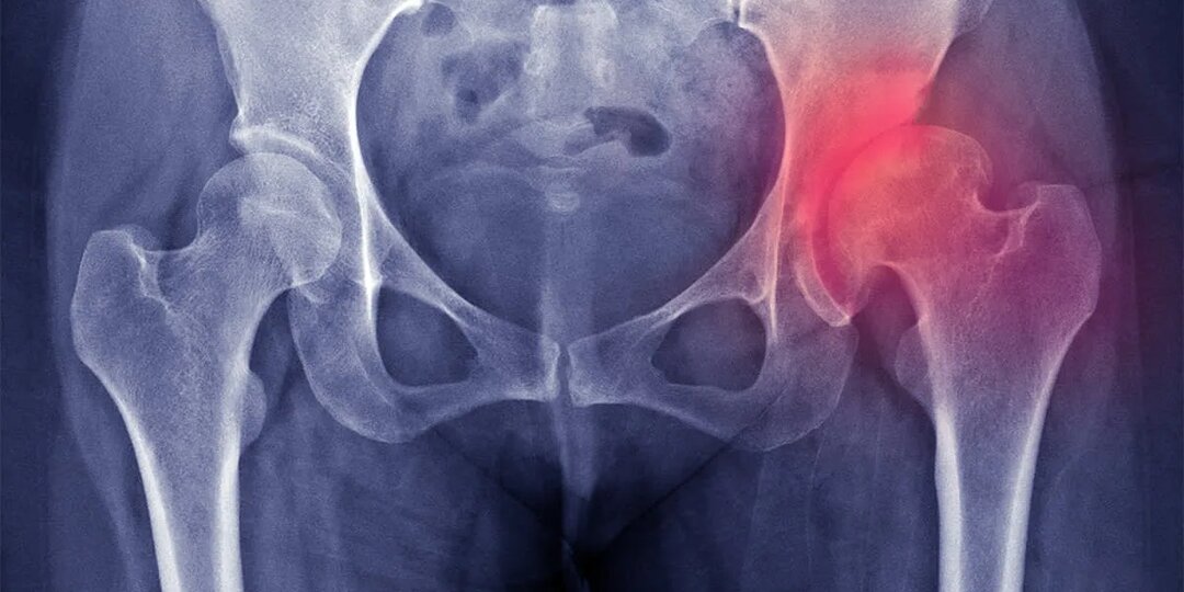 Коксартроз: когда бедро начинает "ныть" по-настоящему и что с этим делать