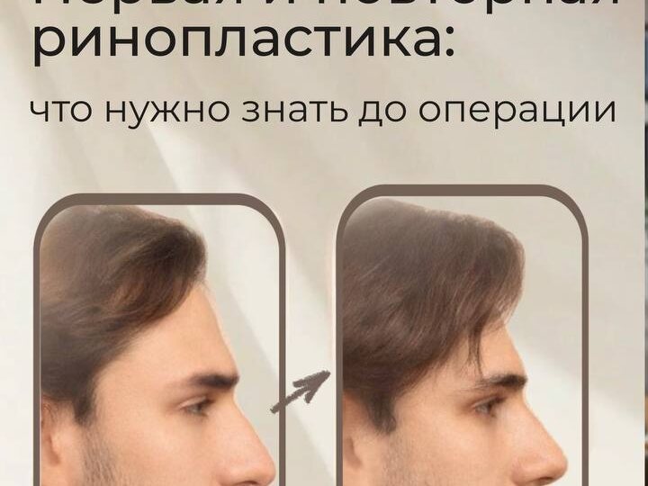 Первая и повторная ринопластика: что нужно знать до операции.