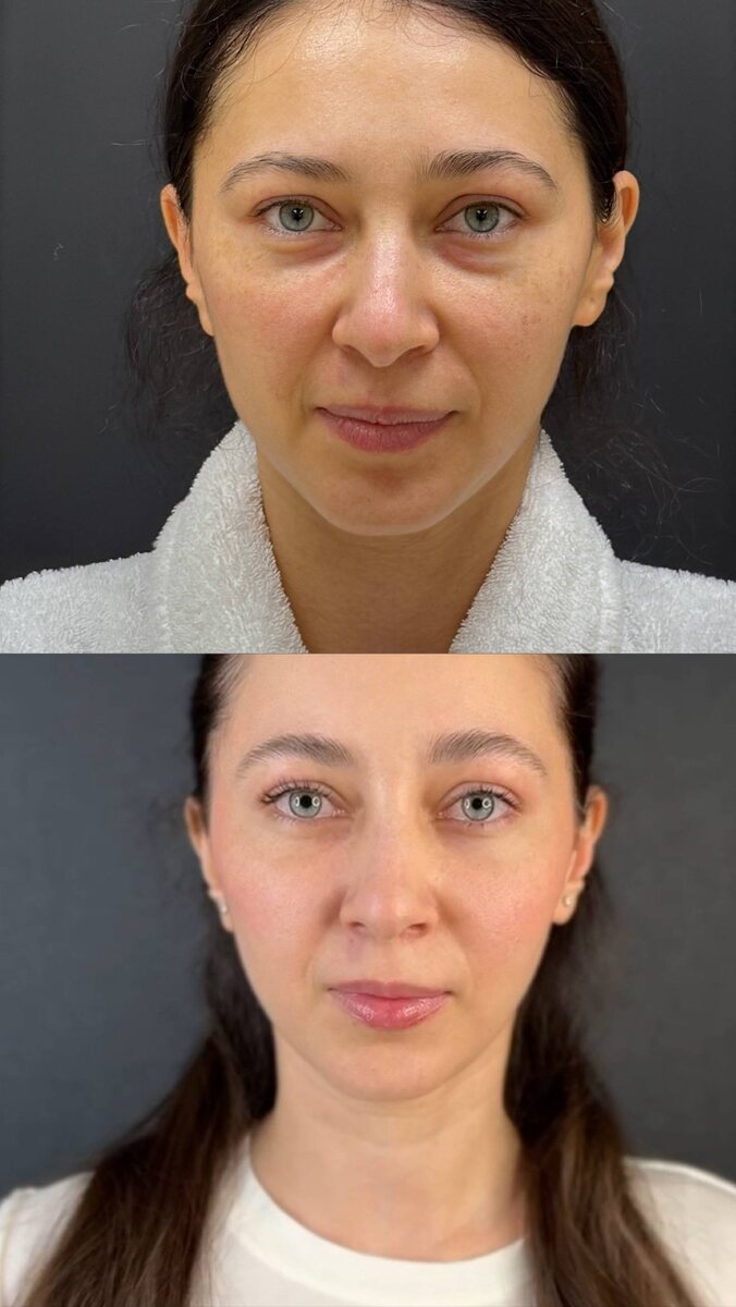 Нижняя трансконъюнктивальная блефаропластика с липофилингом