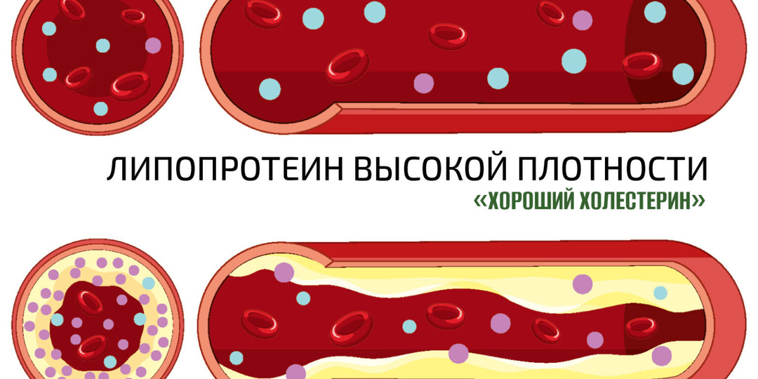 Высокий холестерин. Что делать?