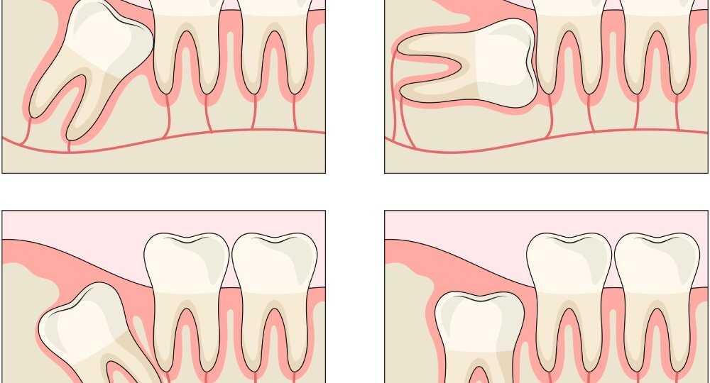 Могут ли восьмые зубы вызывать дисфункцию ВНЧС?