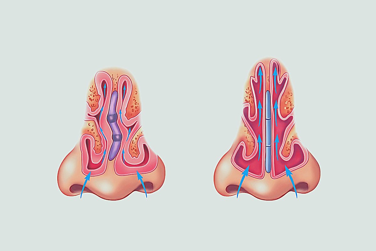 Искривление носовой перегородки