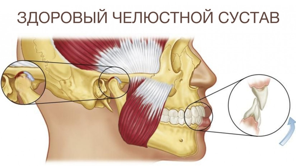 Височно-нижнечелюстной сустав в норме без нарушений прикуса