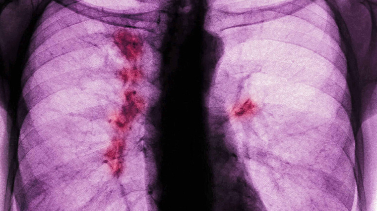    Рак легких: причины, симптомы по стадиям, лечение, профилактика онкологии, химиотерапия, выживаемость. Фото: www.legion-media.com/BSIP