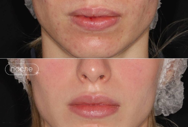 ЛЕЧЕНИЕ АКНЕ