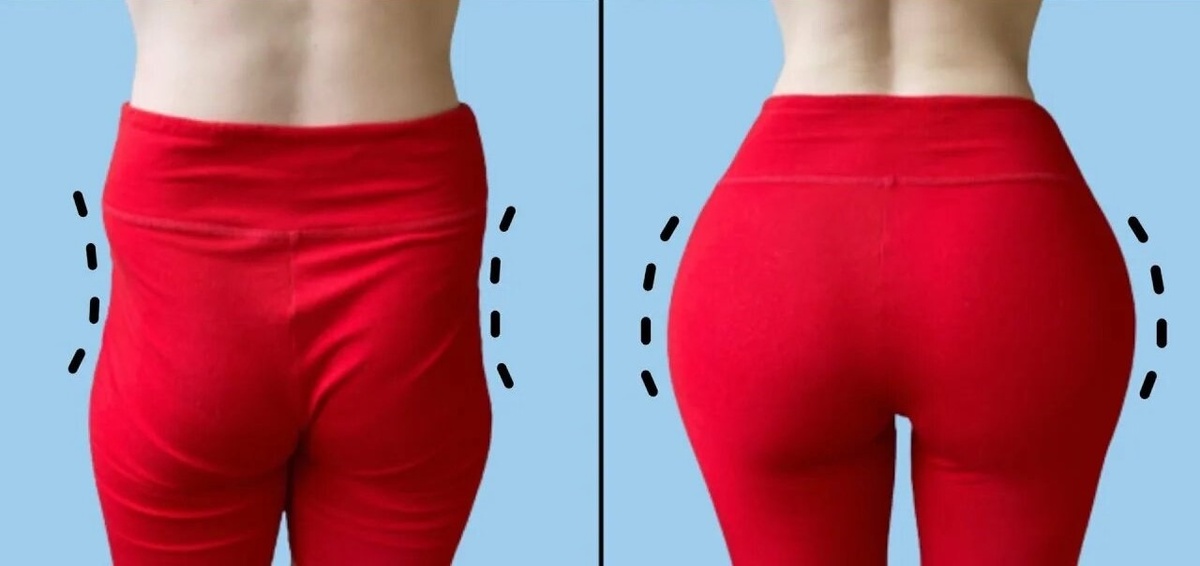 Бразильские ягодицы