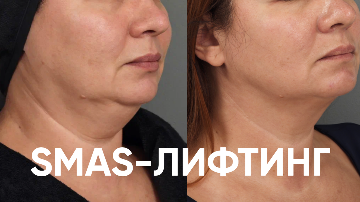 Результат через 3 месяца после процедуры