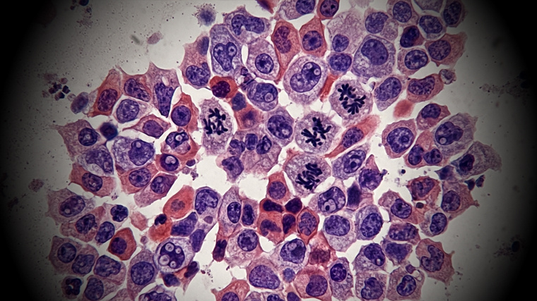    Рак шейки почки: причины, симптомы по стадиям, лечение, профилактика онкологии, химиотерапия, выживаемость. Фото: 5-tv.ru