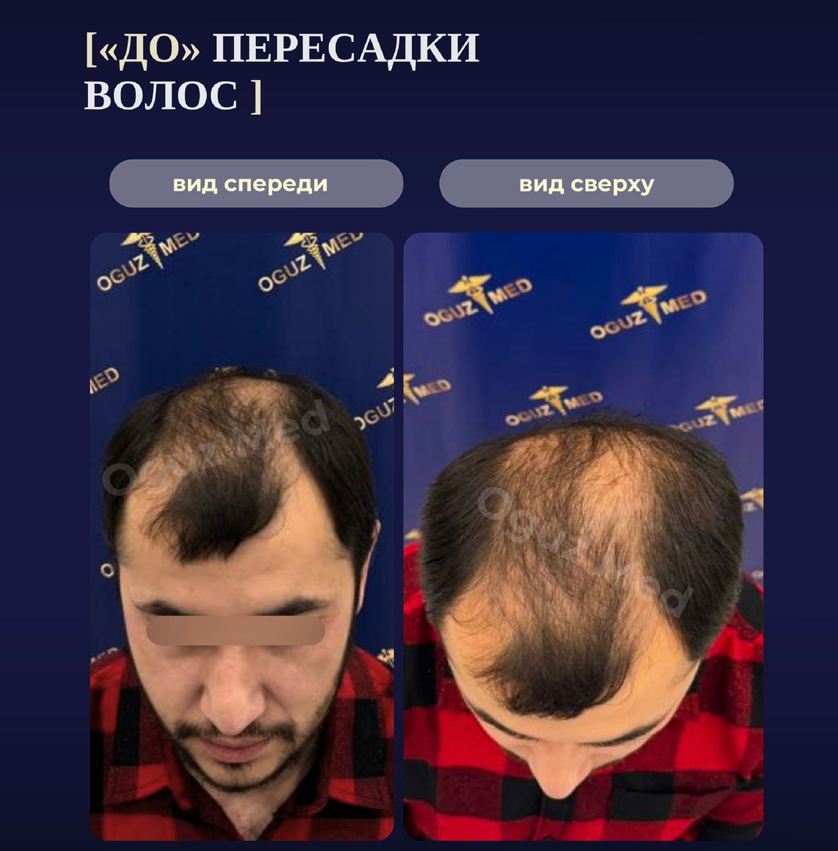 Изображение: кейс ОгузМед, до пересадки волос